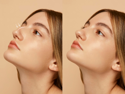rhinoplasty